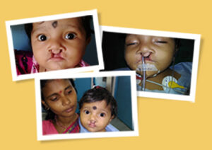 sibu before cleft surgery